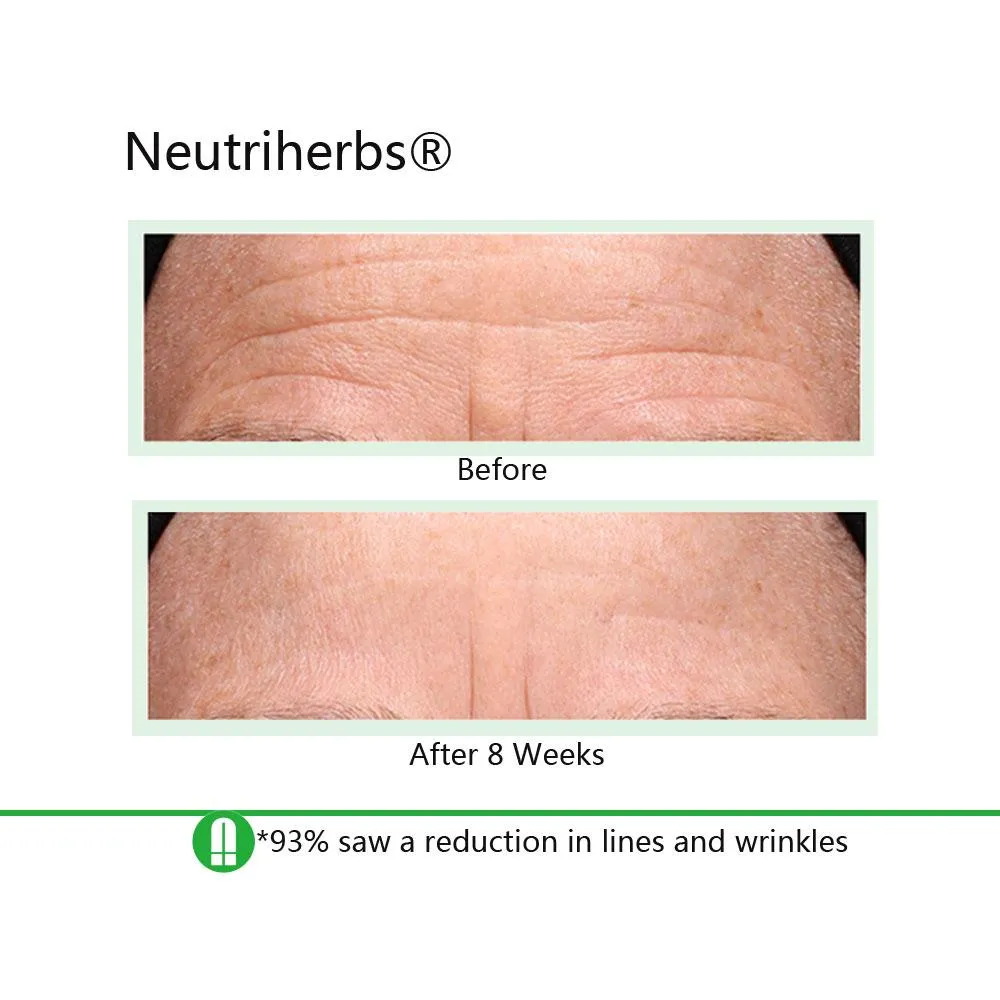 Neutriherbs® Retinol Cream And Serum Bundle For Acne & Aging & Oily Skin