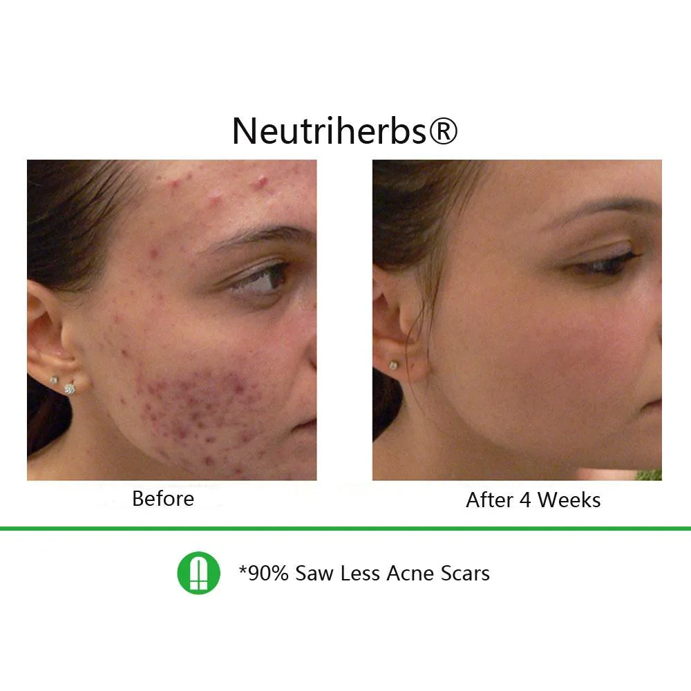 Neutriherbs® Retinol Cream And Serum Bundle For Acne & Aging & Oily Skin